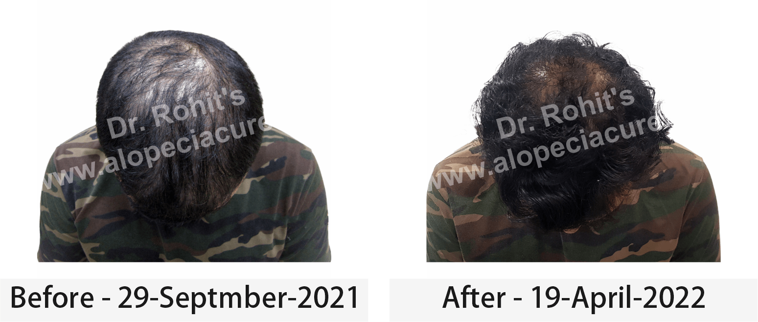 hair loss treatment